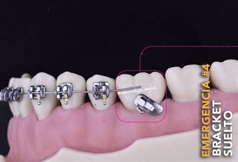 que pasa si me trago un bracket metalico|como tragar un bracket.